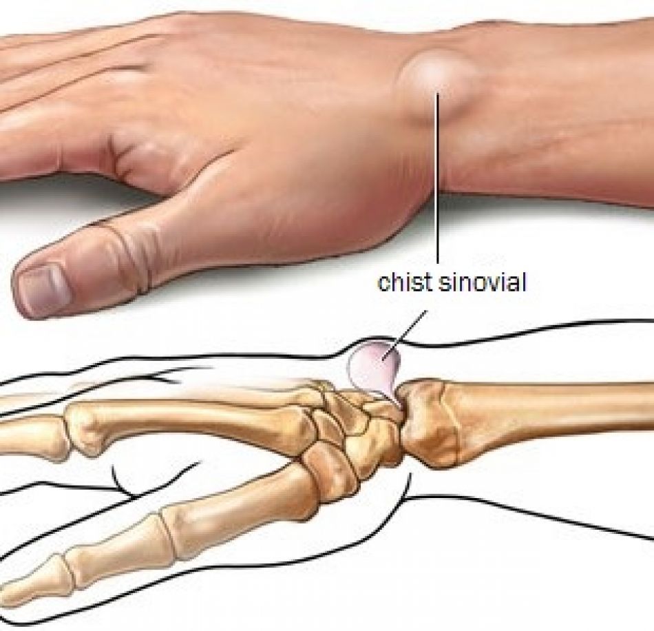 simptome ale leziunilor tendoanelor genunchiului tratament de subluxatie articulara